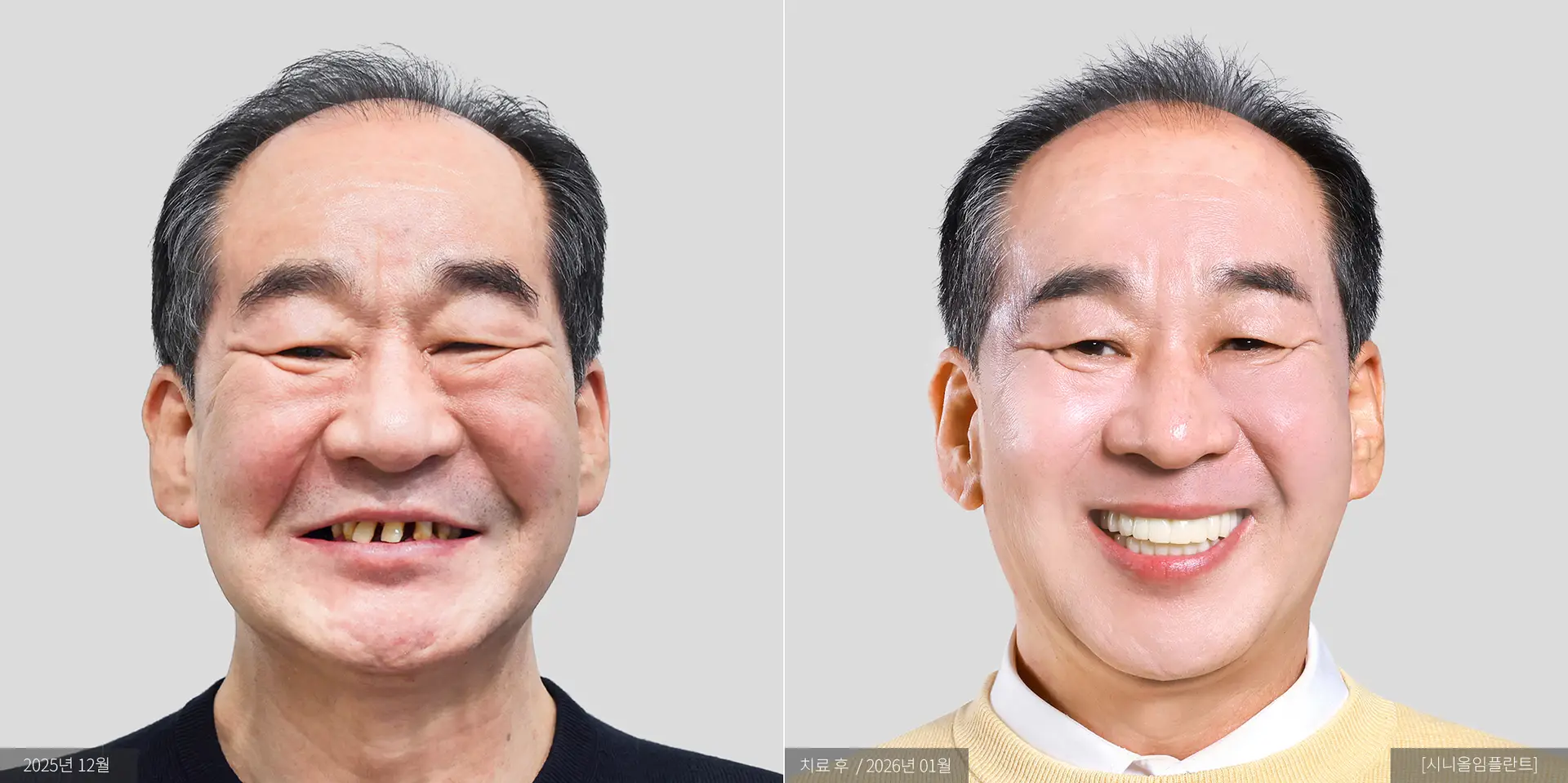 강희종 전후 사진
