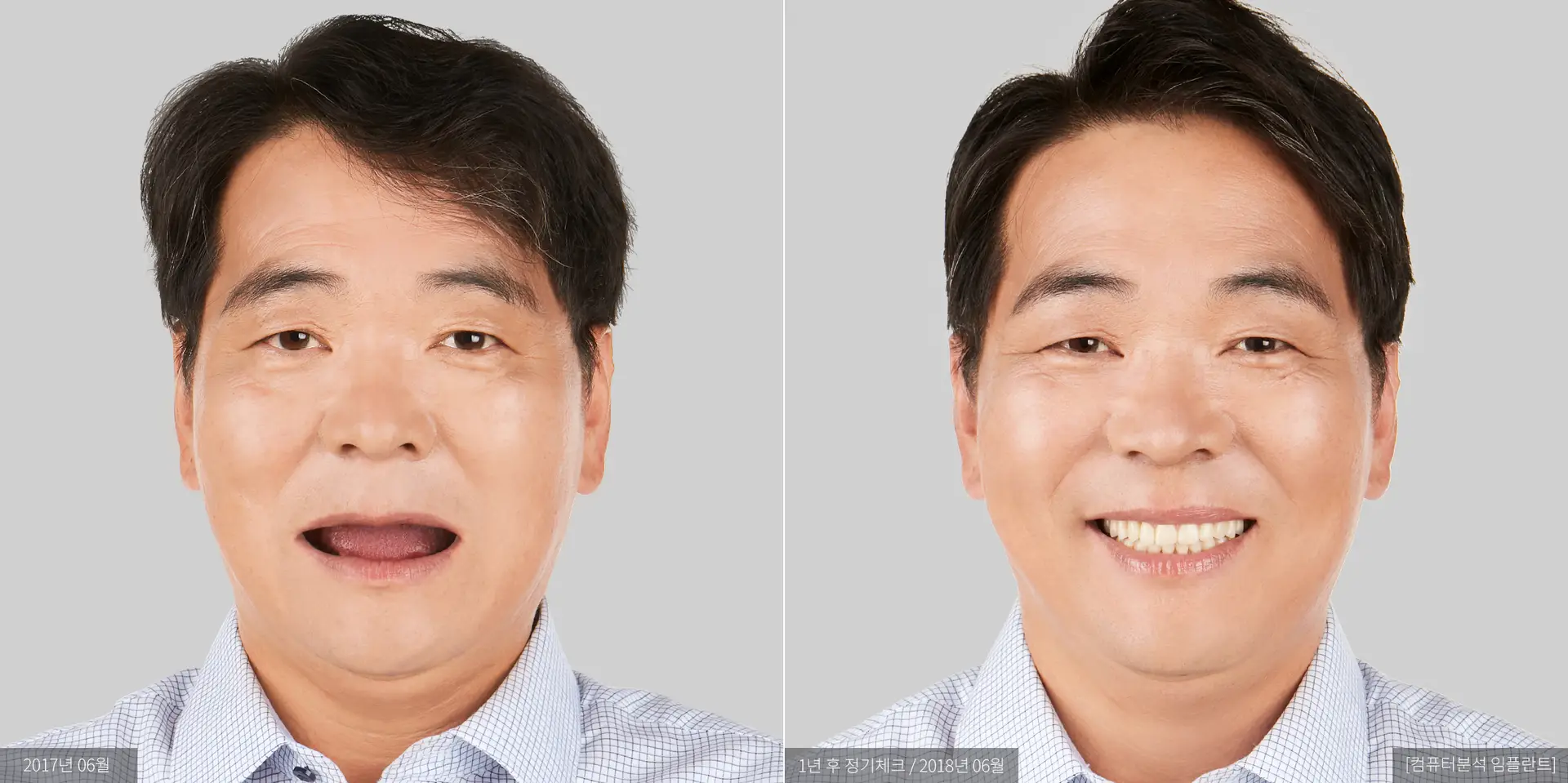 권용근 전후 사진