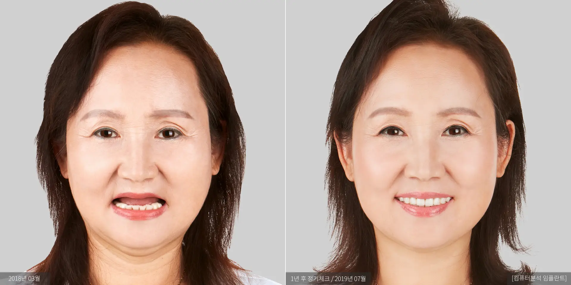 김순희 전후 사진