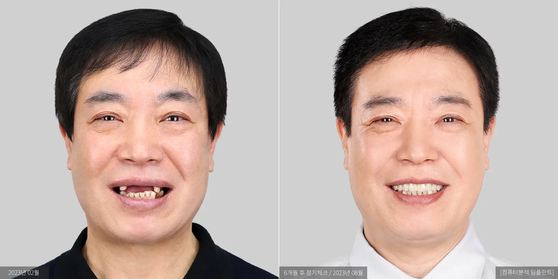 김춘식 전후 사진