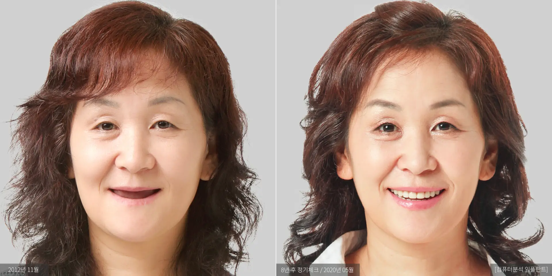 박인숙 전후 사진