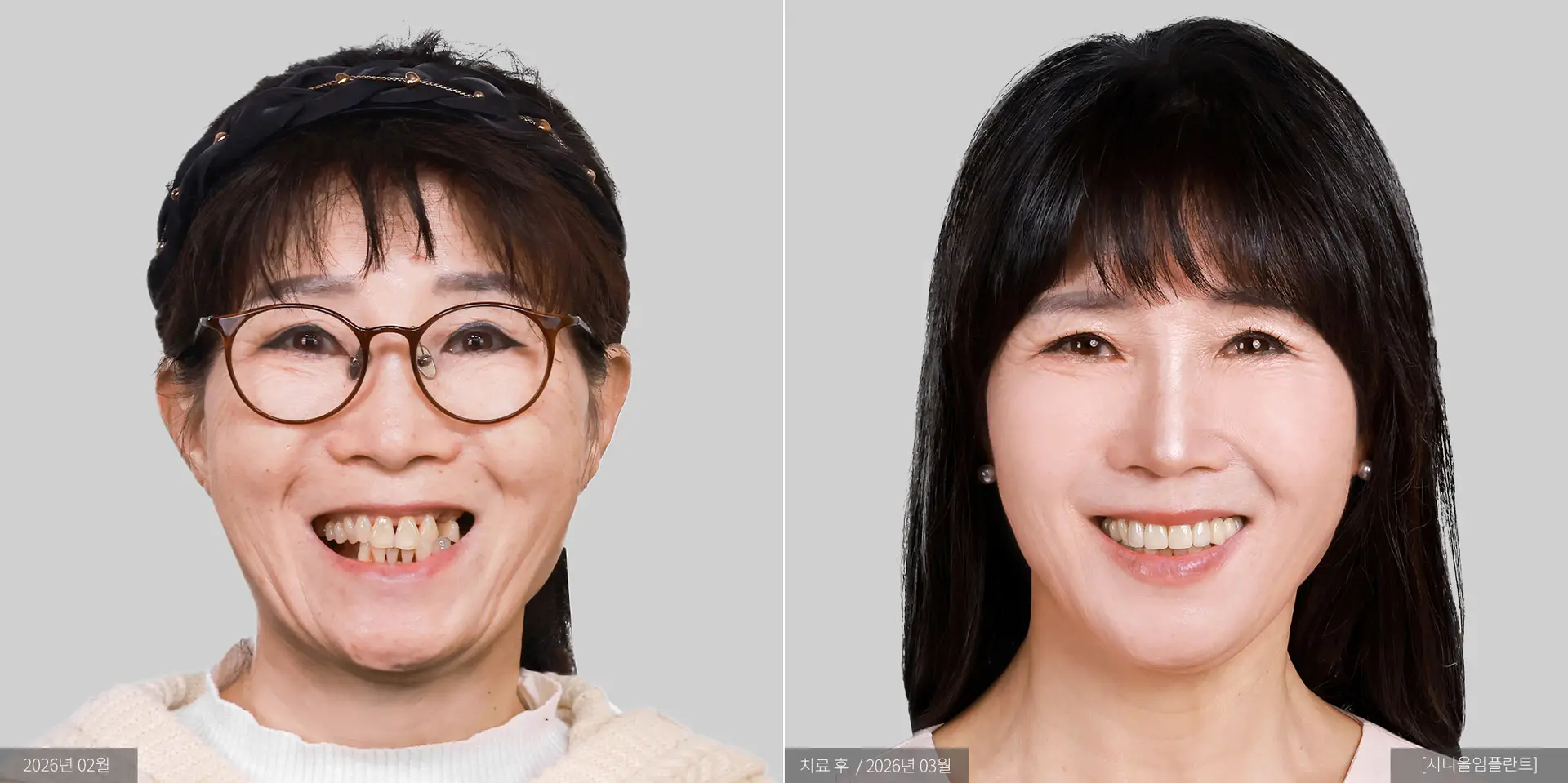 신소해 전후 사진