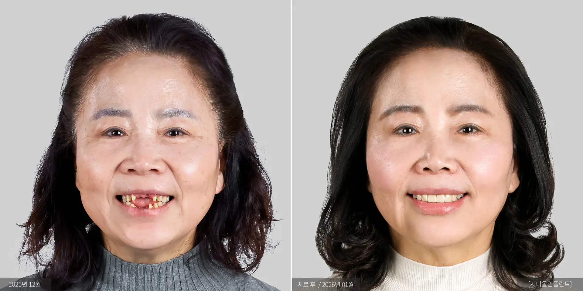 양승님 전후 사진