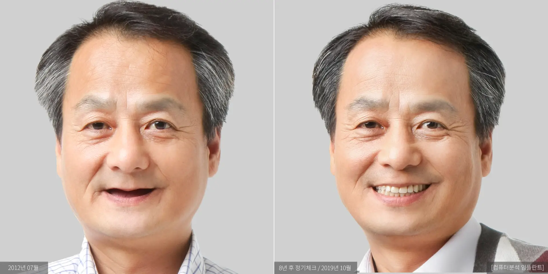 양하영 전후 사진