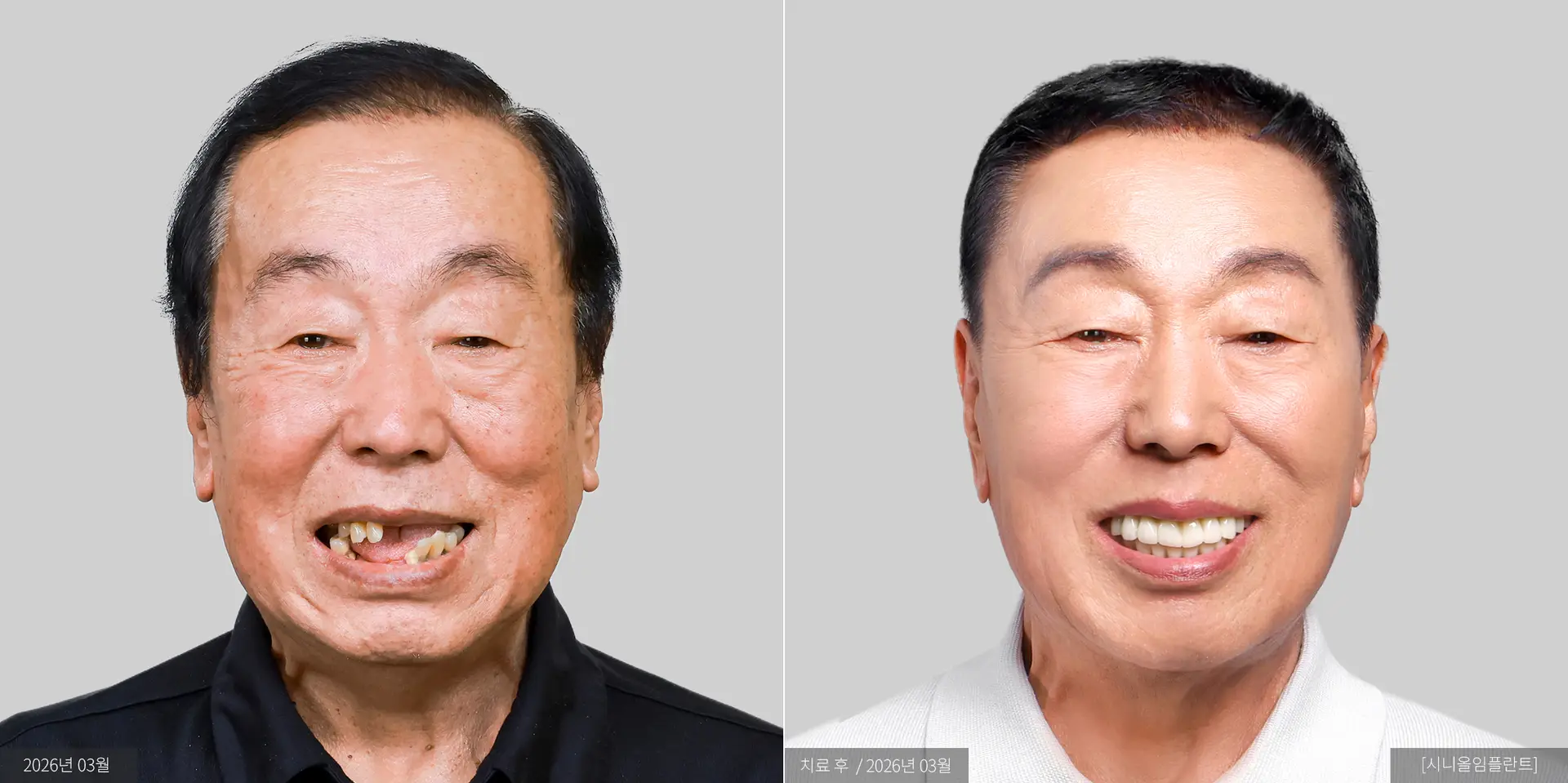 이익철 전후 사진