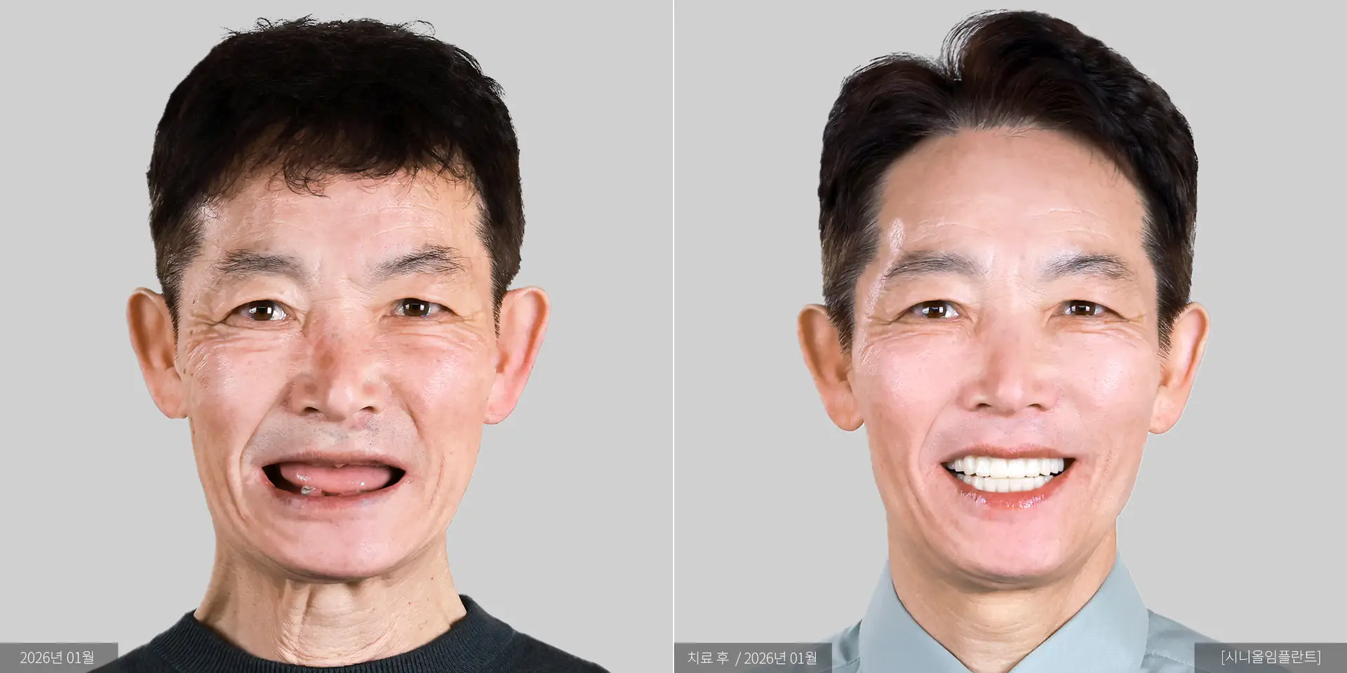 이장원 전후 사진