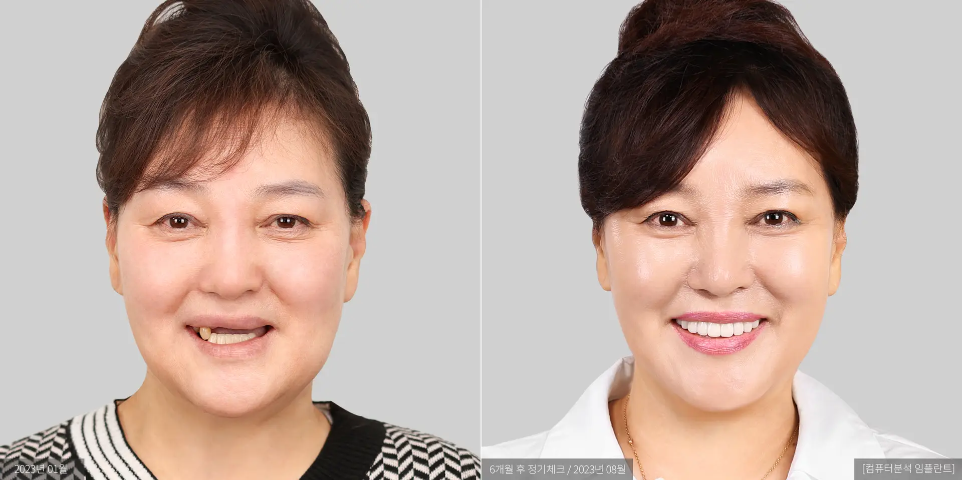 임순옥 전후 사진