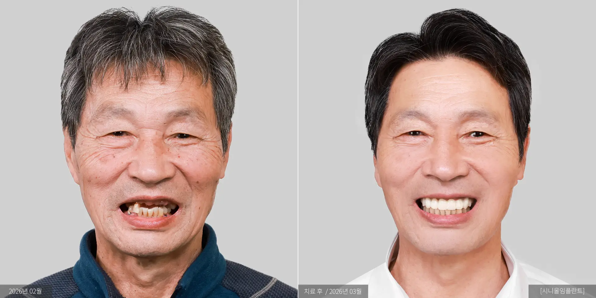 정향복 전후 사진