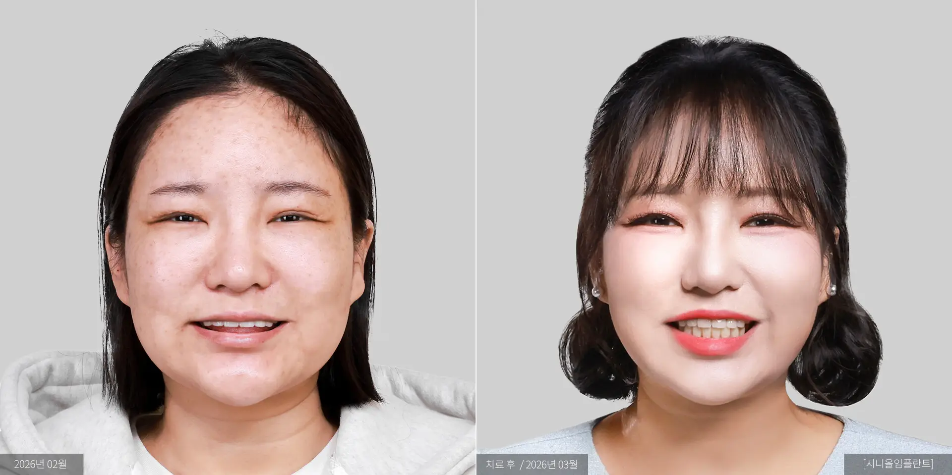 최나리 전후 사진