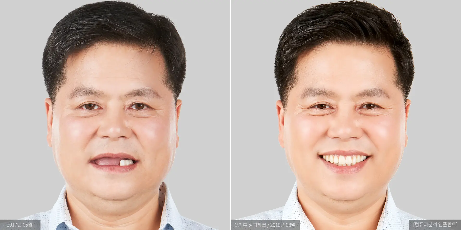한규현 전후 사진