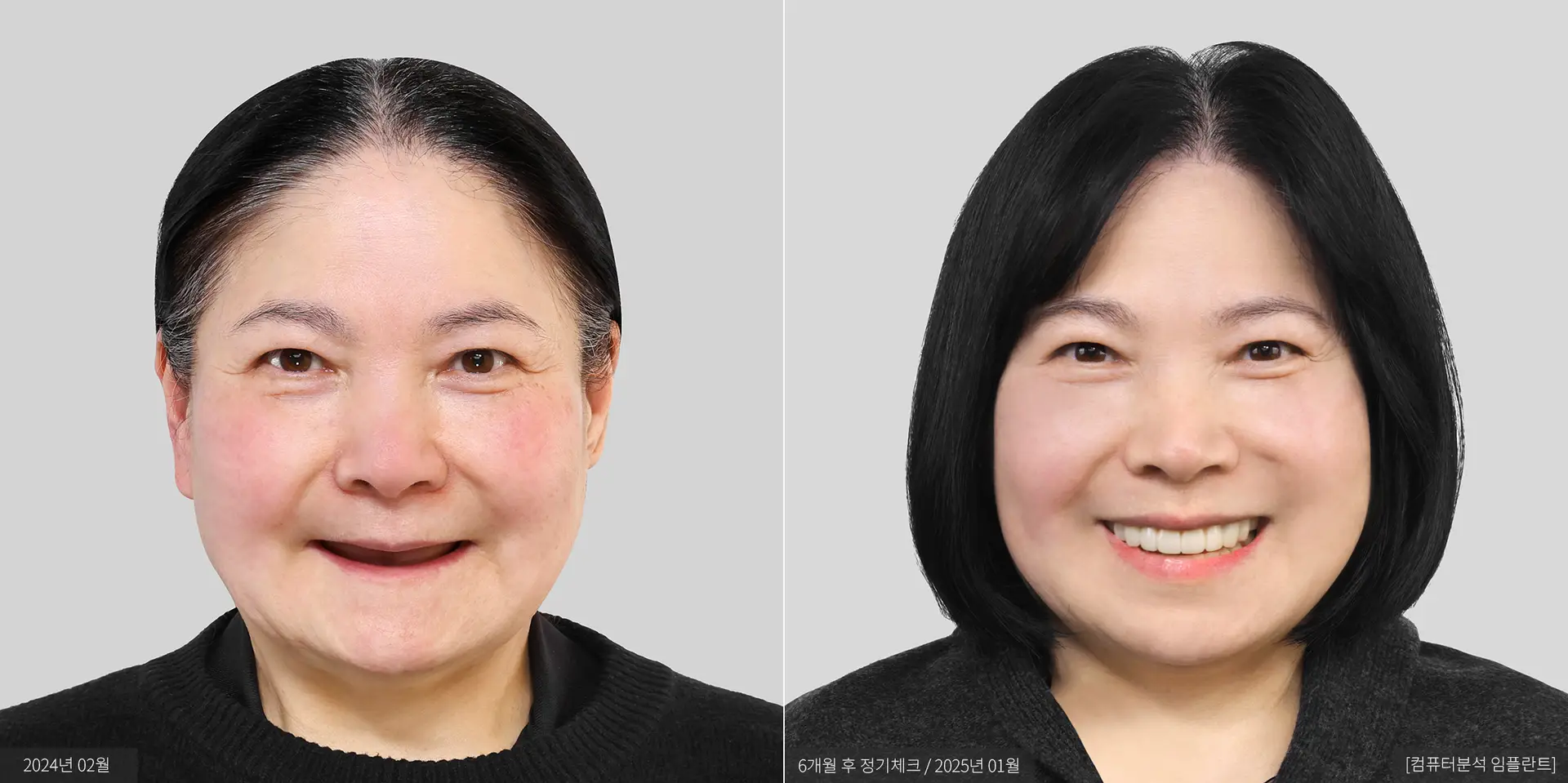황옥희 전후 사진