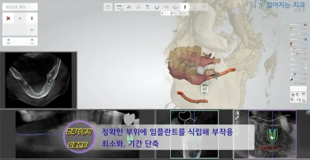 3D CT 및 3차원 디지털 시뮬레이션을 활용하여 오차를 줄이고 정확한 위치에 임플란트를 식립하는 컴퓨터 분석 임플란트 화면