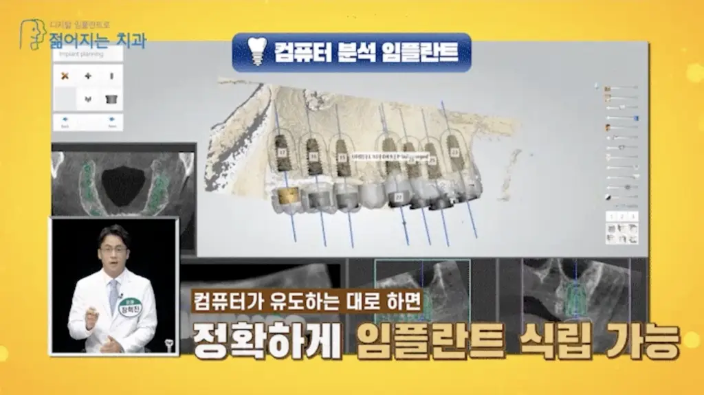 강남역 임플란트 젊어지는 치과: 퓨터 3D 분석 프로그램을 통해 임플란트 식립 위치와 경로를 오차 없이 정밀하게 계획하는 디지털 모의수술 화면